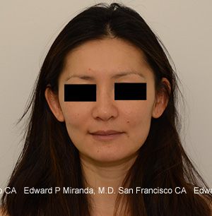 Dermal Fillers Before & After