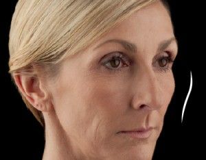 Dermal Fillers Before & After