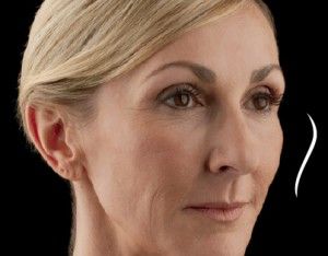 Dermal Fillers Before & After