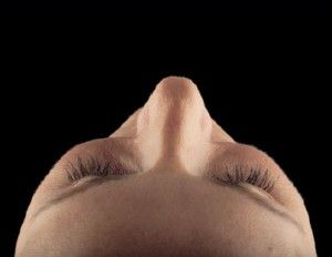 Dermal Fillers Before & After