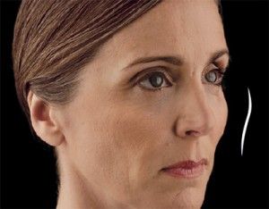 Dermal Fillers Before & After