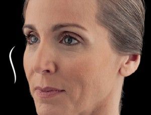 Dermal Fillers Before & After