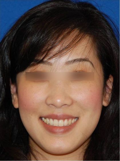 Dermal Fillers Before & After