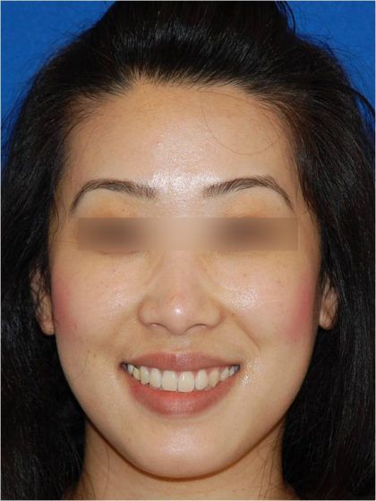 Dermal Fillers Before & After