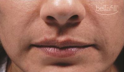 Dermal Fillers Before & After