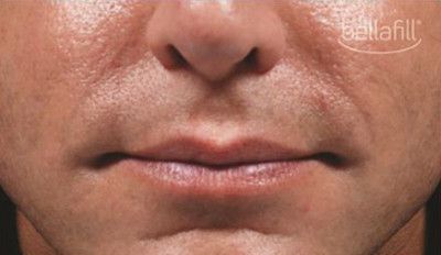Dermal Fillers Before & After