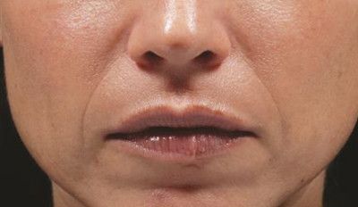 Dermal Fillers Before & After