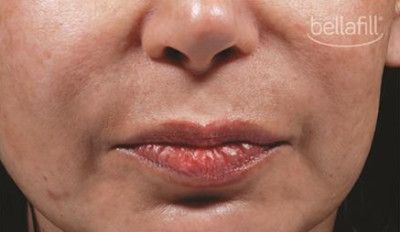 Dermal Fillers Before & After