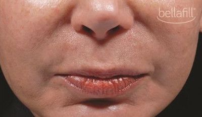 Dermal Fillers Before & After