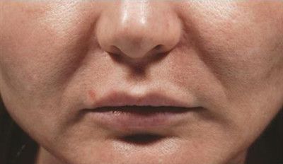 Dermal Fillers Before & After