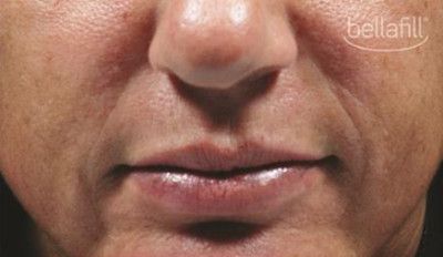 Dermal Fillers Before & After