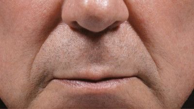 Dermal Fillers Before & After