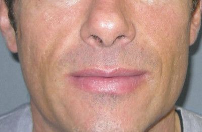 Dermal Fillers Before & After