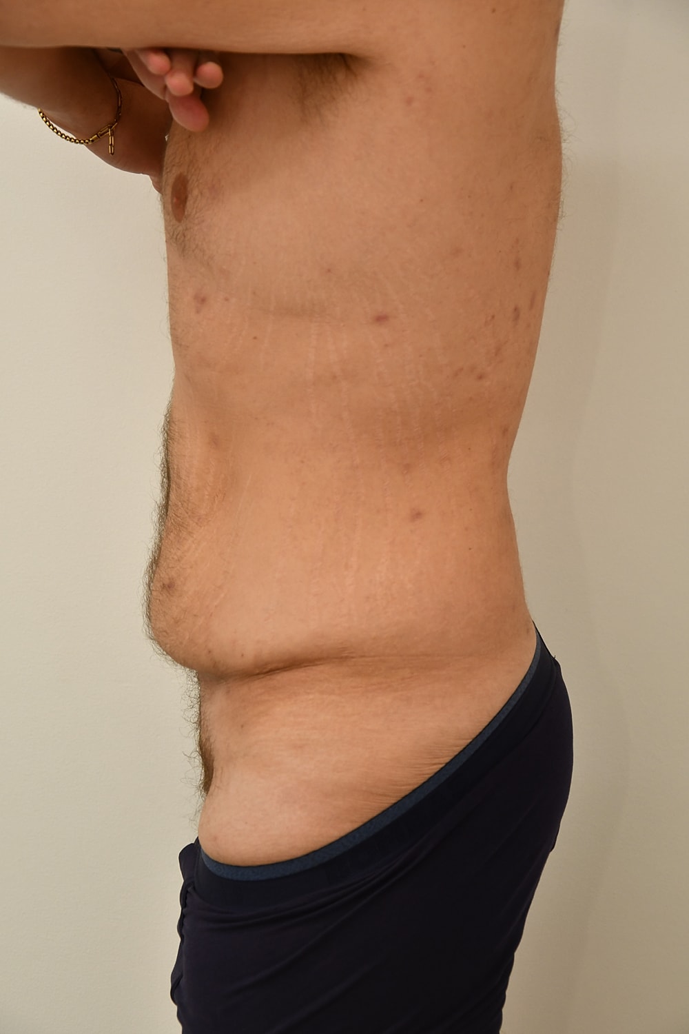 Body Lift Before & After