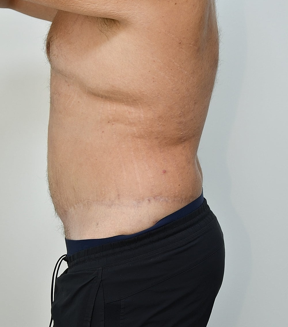 Body Lift Before & After