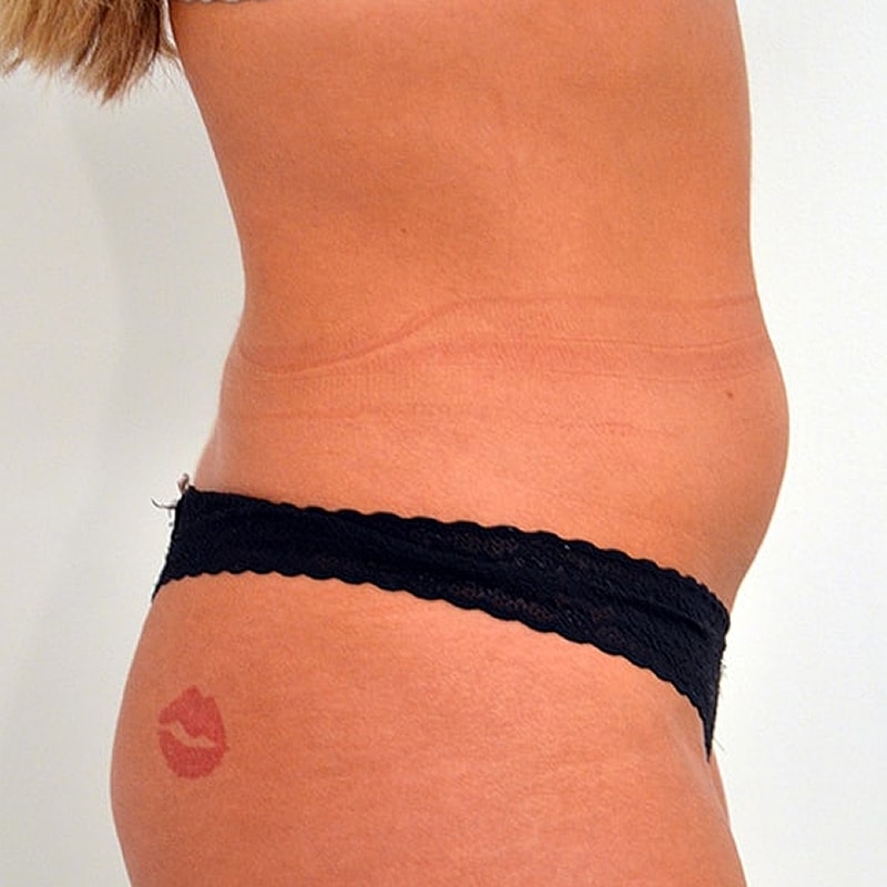 Liposuction Before & After