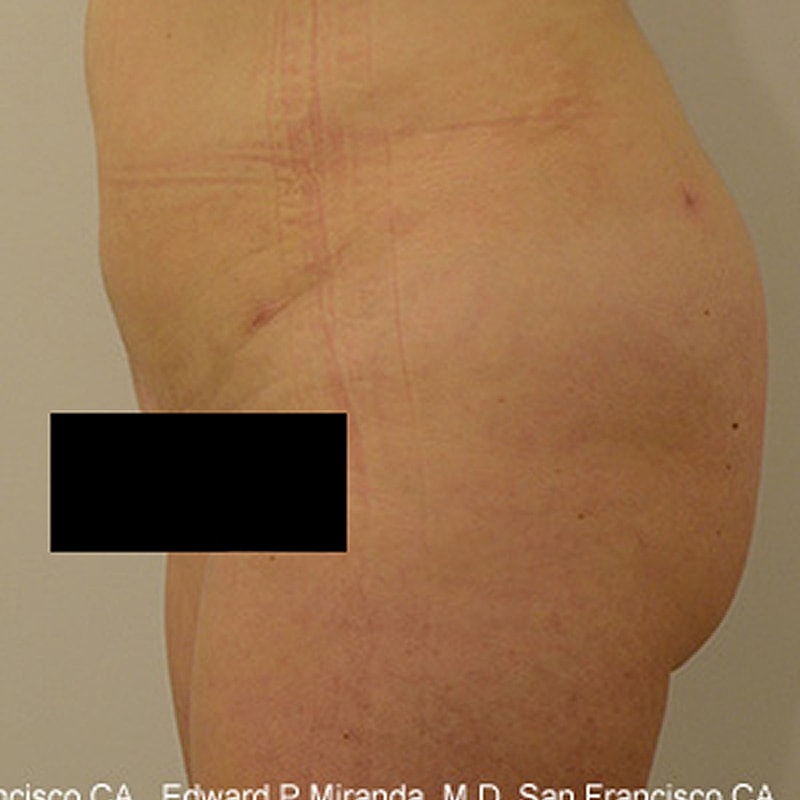 Liposuction Before & After
