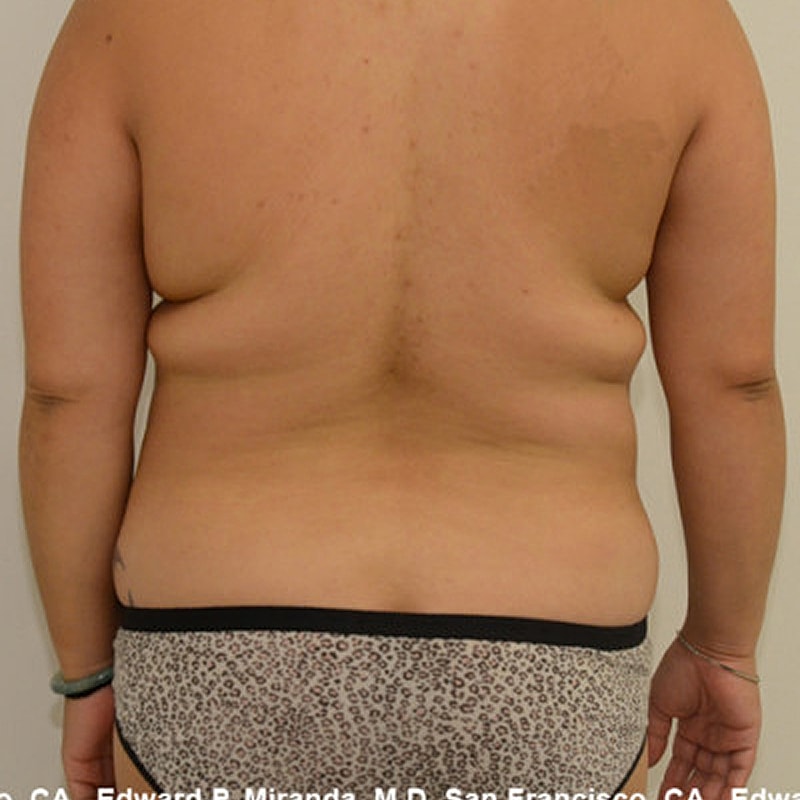 Liposuction Before & After
