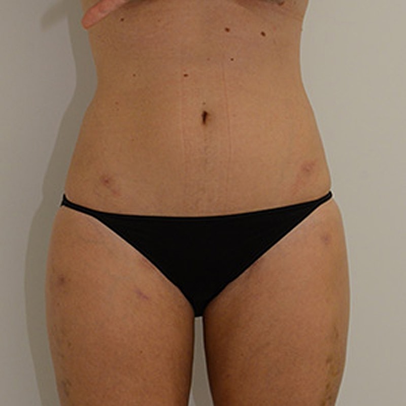 Liposuction Before & After