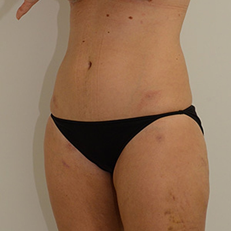 Liposuction Before & After