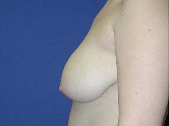 Breast Reduction Before & After