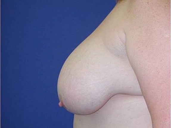 Breast Reduction Before & After