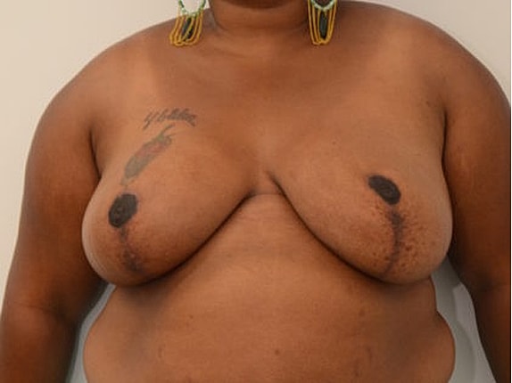 Breast Reduction Before & After