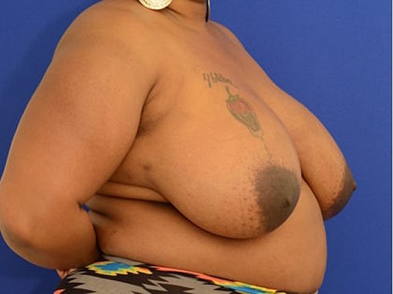 Breast Reduction Before & After