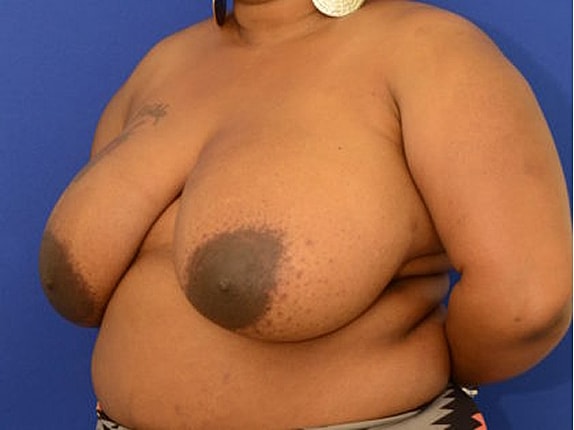 Breast Reduction Before & After