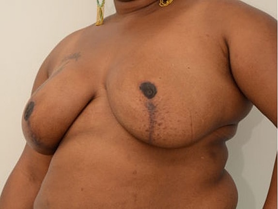 Breast Reduction Before & After
