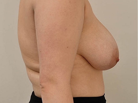 Breast Reduction Before & After