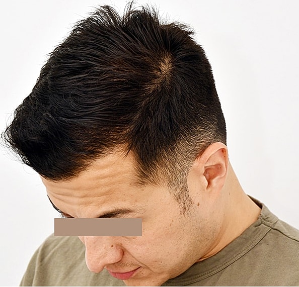 Hair Transplant Before & After