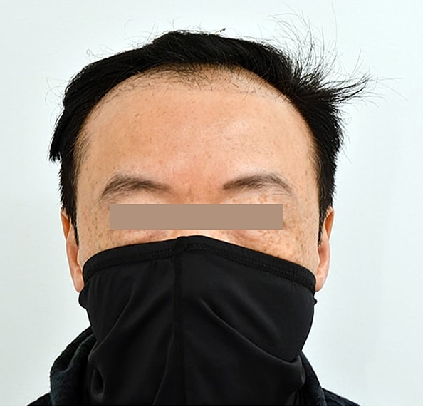 Hair Transplant Before & After