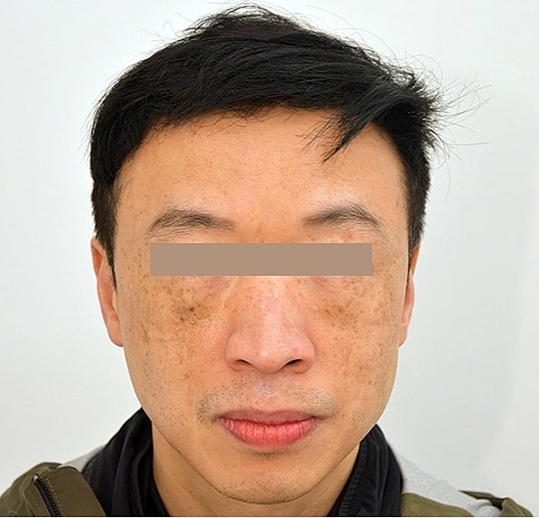 Hair Transplant Before & After