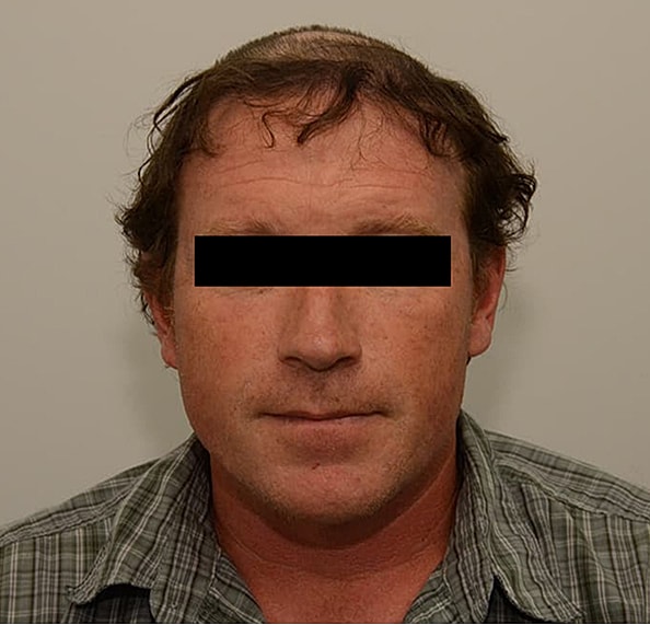 Hair Transplant Before & After