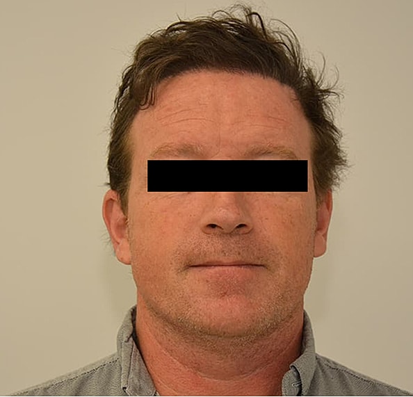 Hair Transplant Before & After