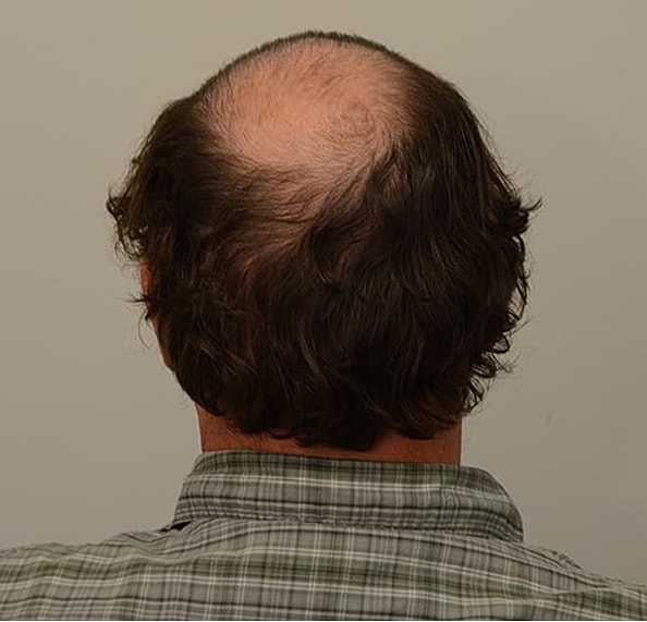 Hair Transplant Before & After