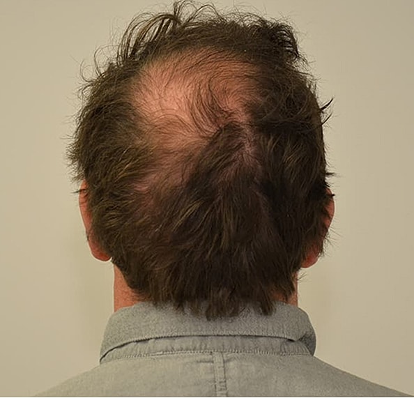 Hair Transplant Before & After