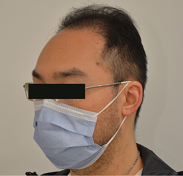 Hair Transplant Before & After