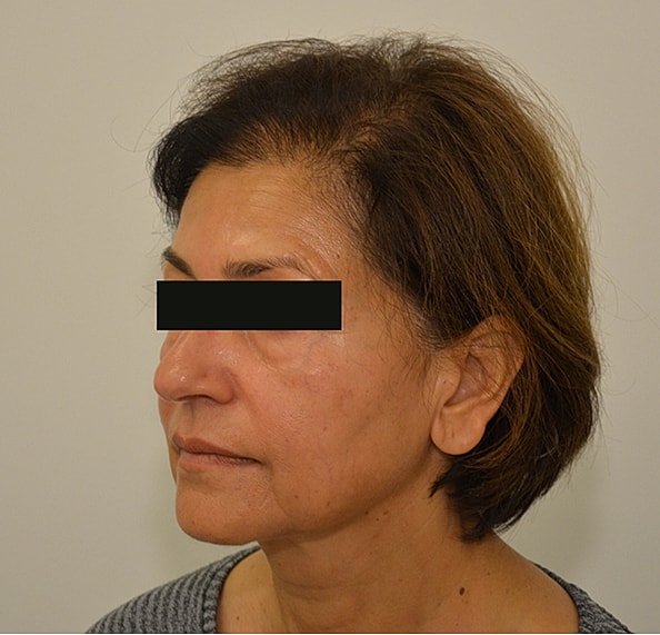 Hair Transplant Before & After