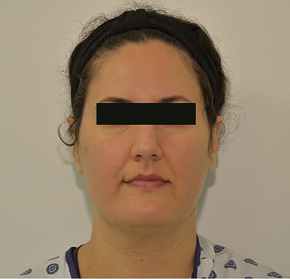 Hair Transplant Before & After