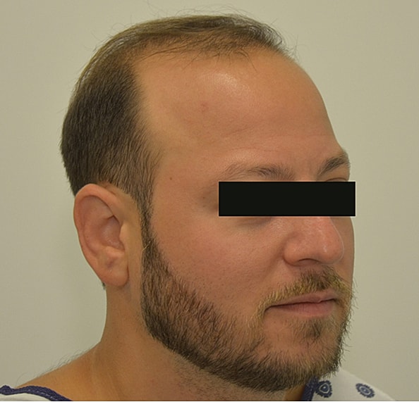 Hair Transplant Before & After