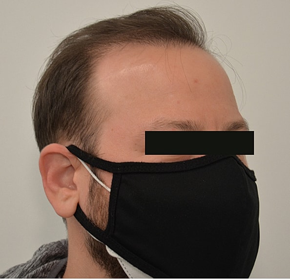 Hair Transplant Before & After