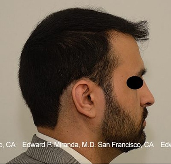 Hair Transplant Before & After