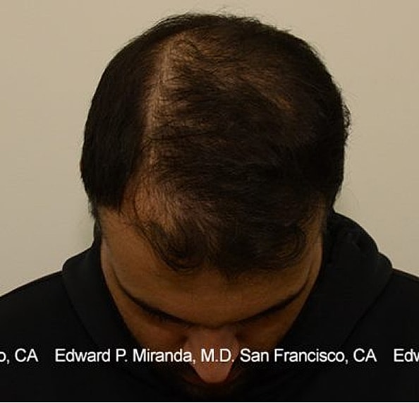 Hair Transplant Before & After