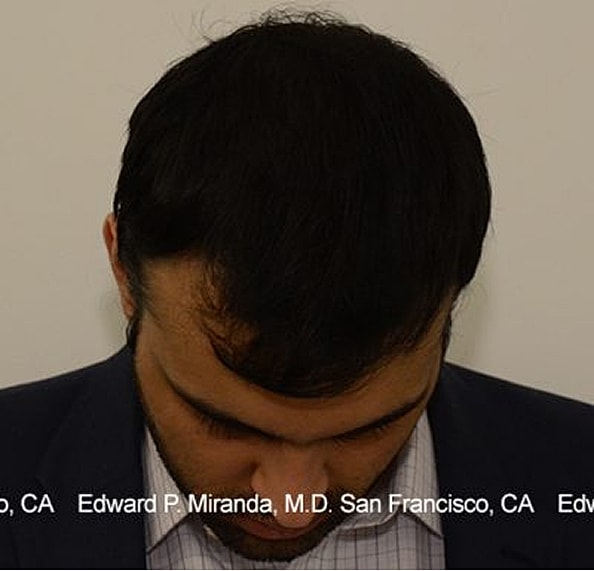 Hair Transplant Before & After