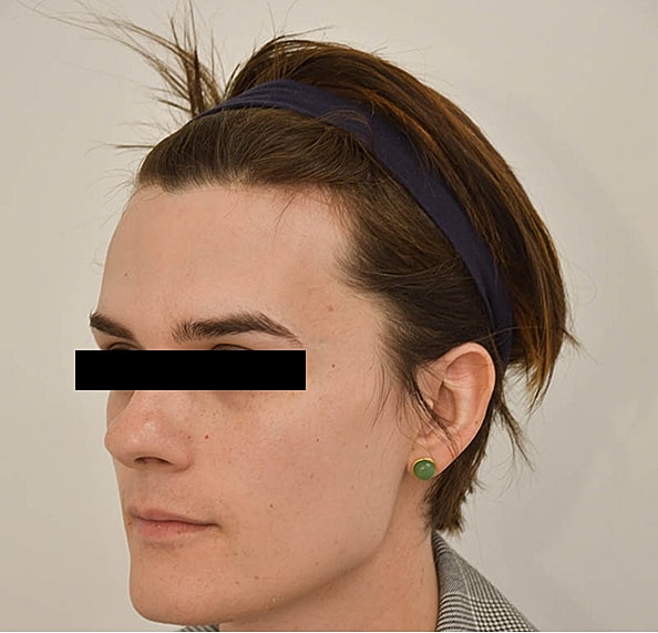 Hair Transplant Before & After