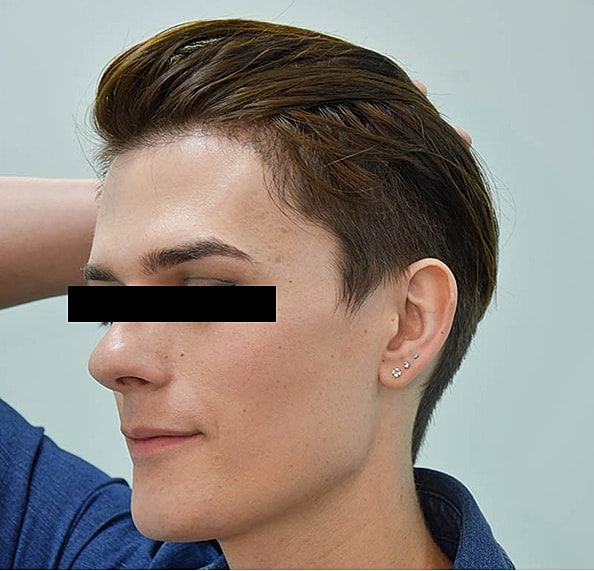 Hair Transplant Before & After