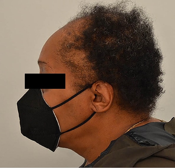 Hair Transplant Before & After