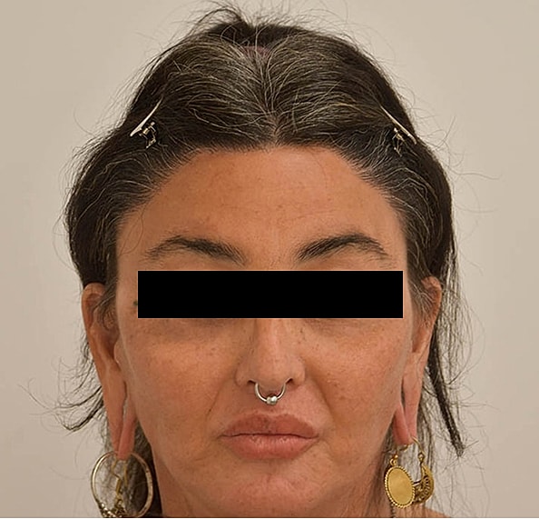 Hair Transplant Before & After